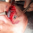 Implant 3D