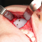 Implant 3D