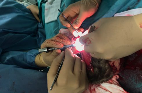 Lekarze z Katowic i Gliwic przyszyli 7-letniej dziewczynce zerwaną przez maszynę skórę głowy